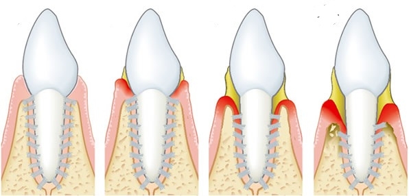 Soins dentaires parodontaux