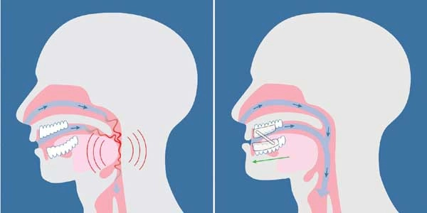 Orthèses dentaires anti apnée du sommeil