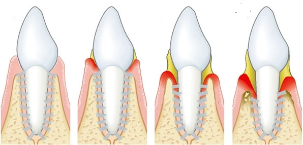 Soins dentaires parodontaux